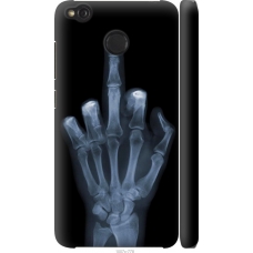 Чохол на Xiaomi Redmi 4X Рука через рентген 1007m-778